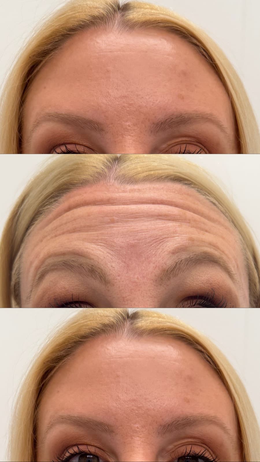 Botox before and after at Prestige Beauty Lounge