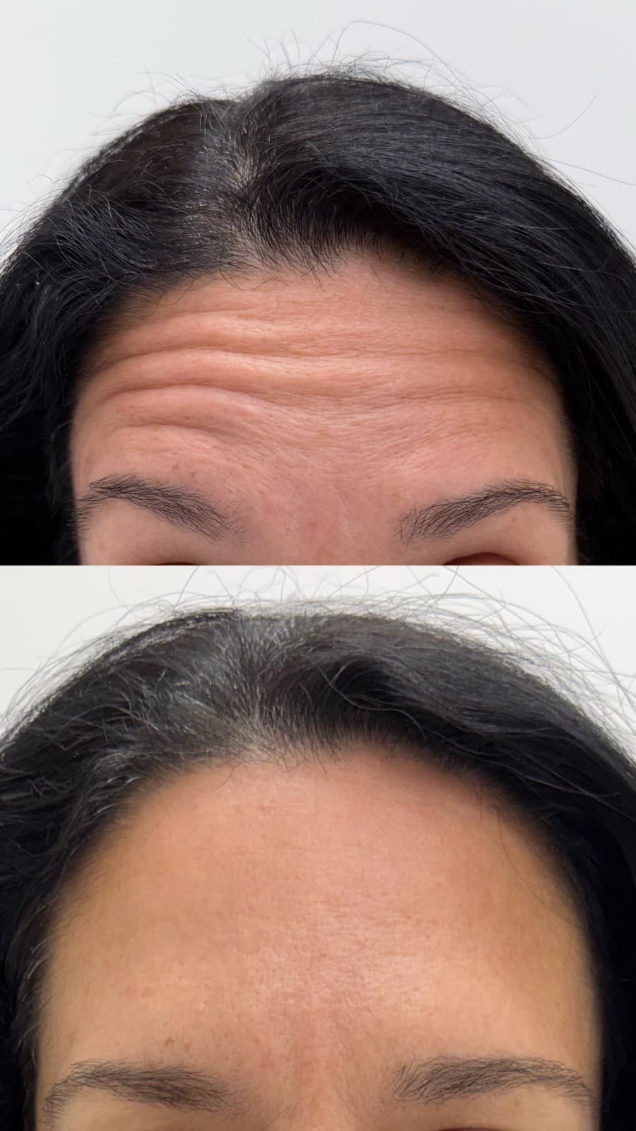 Botox treating forehead lines and frown lines