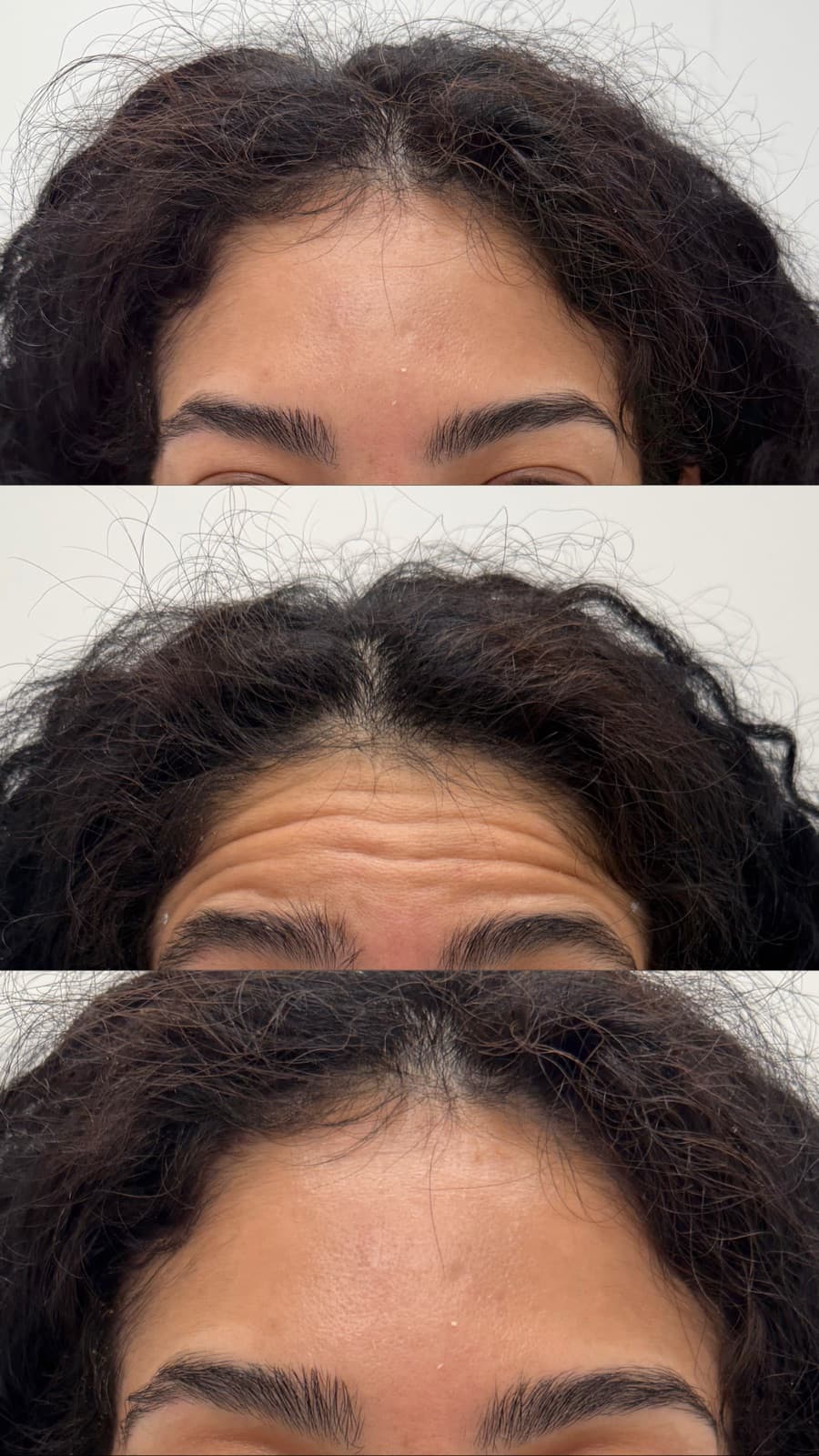 Botox wrinkle relaxing as part of full-face rebalancing