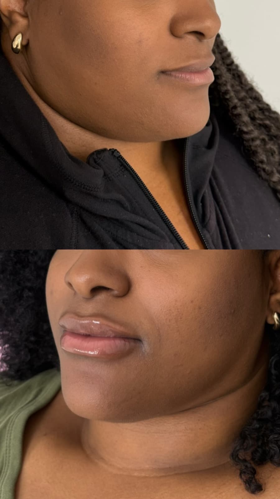 Facial balancing with lip filler by a licensed RN injector