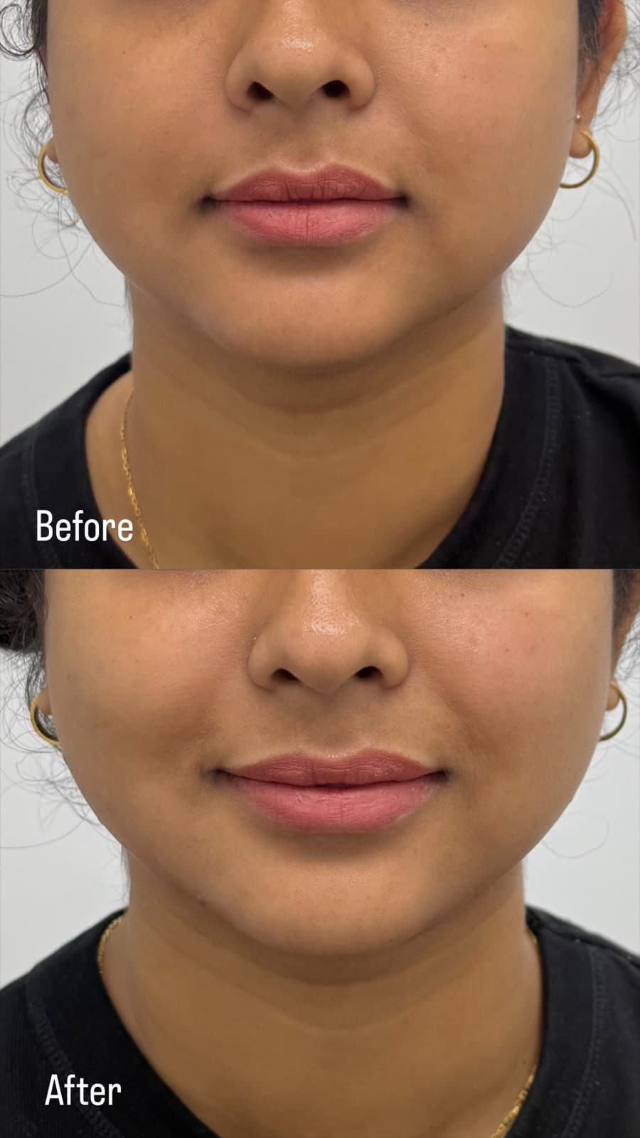 Facial rebalancing softening smile lines and the lower face