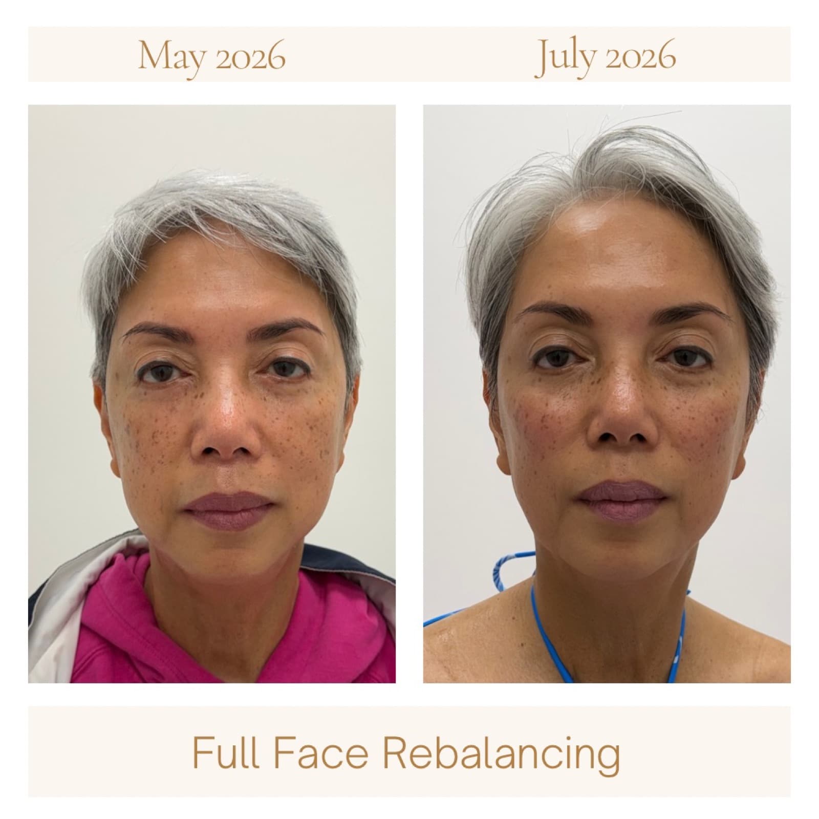 Full-face rebalancing combining Botox and dermal filler