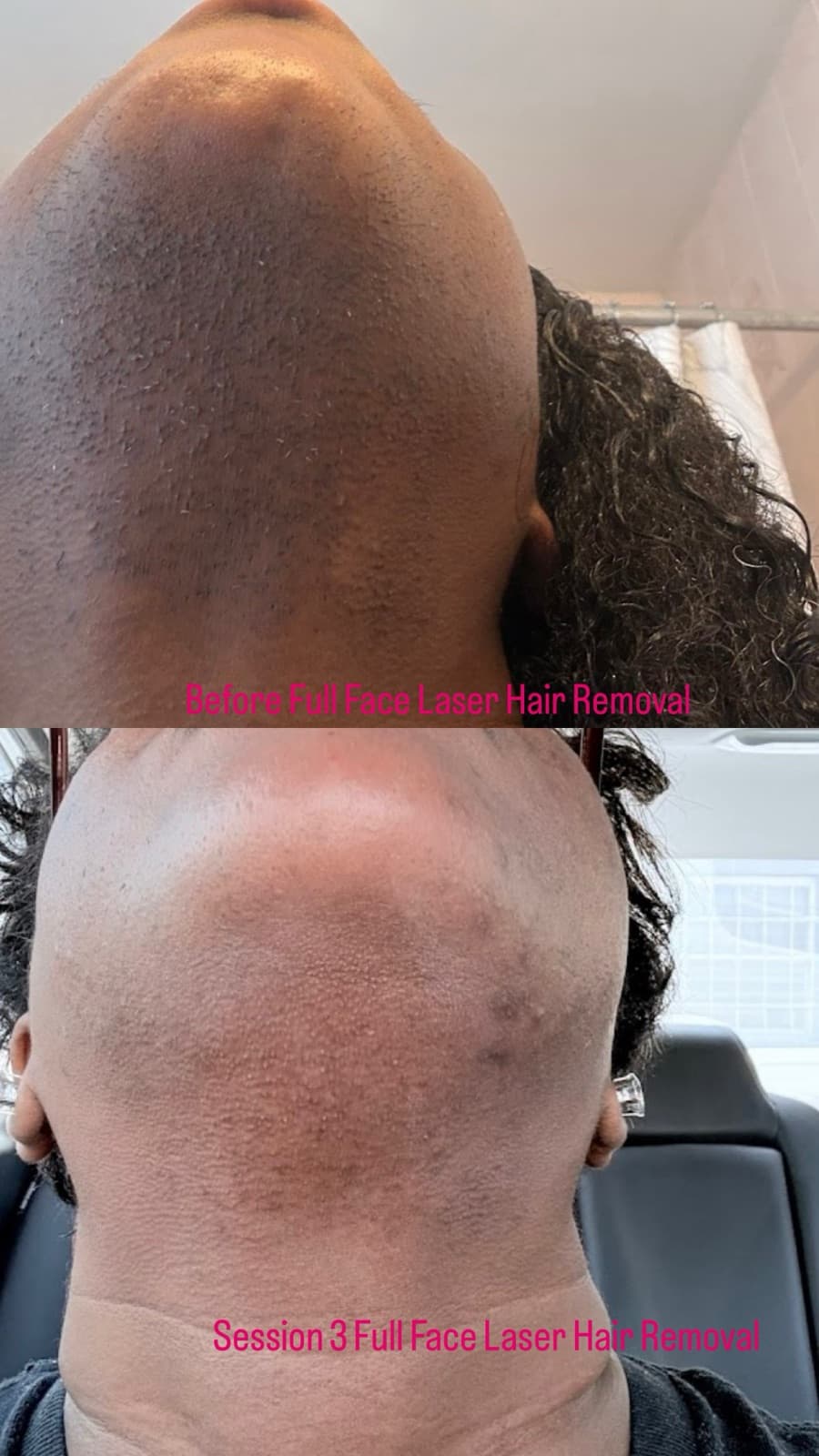 Laser hair removal treating hair growth on the neck