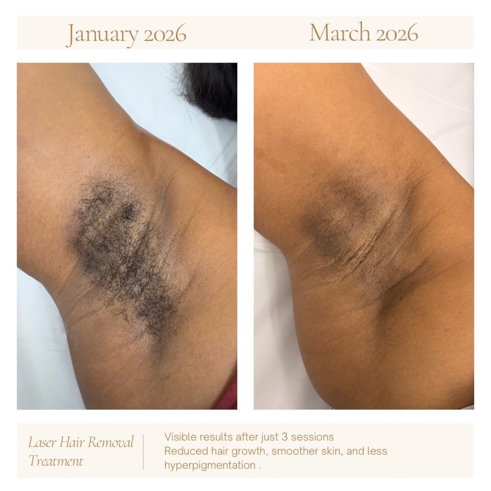 Candela GentleYAG laser hair removal on the underarms