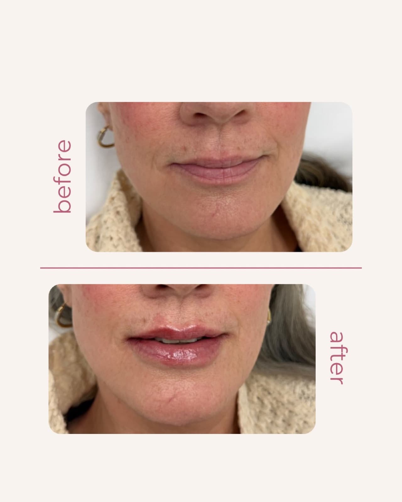 Lip filler placed by a licensed RN injector in our medical suite