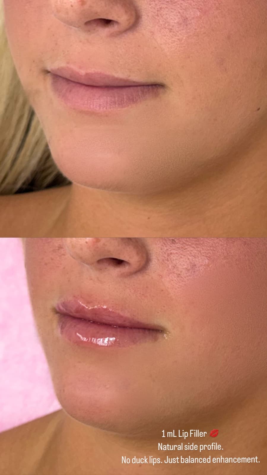 A one millilitre Restylane lip enhancement at Prestige Beauty Lounge