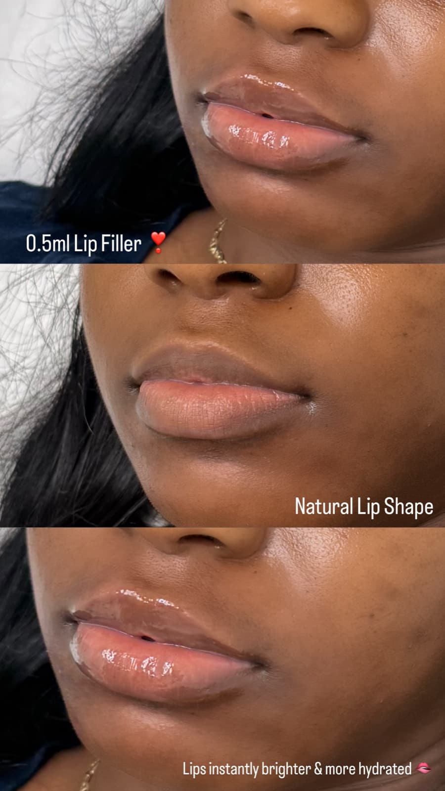 A half syringe lip enhancement with soft, natural results
