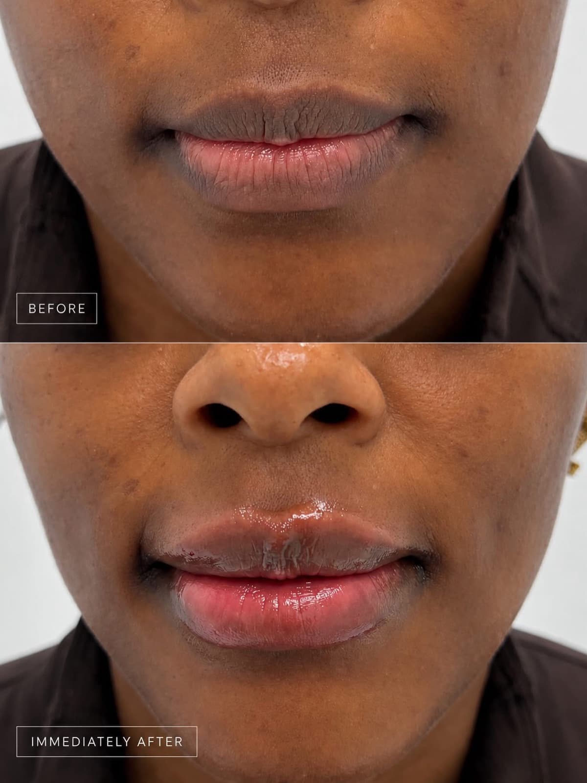 Hyaluronic acid lip filler restoring volume to the lips