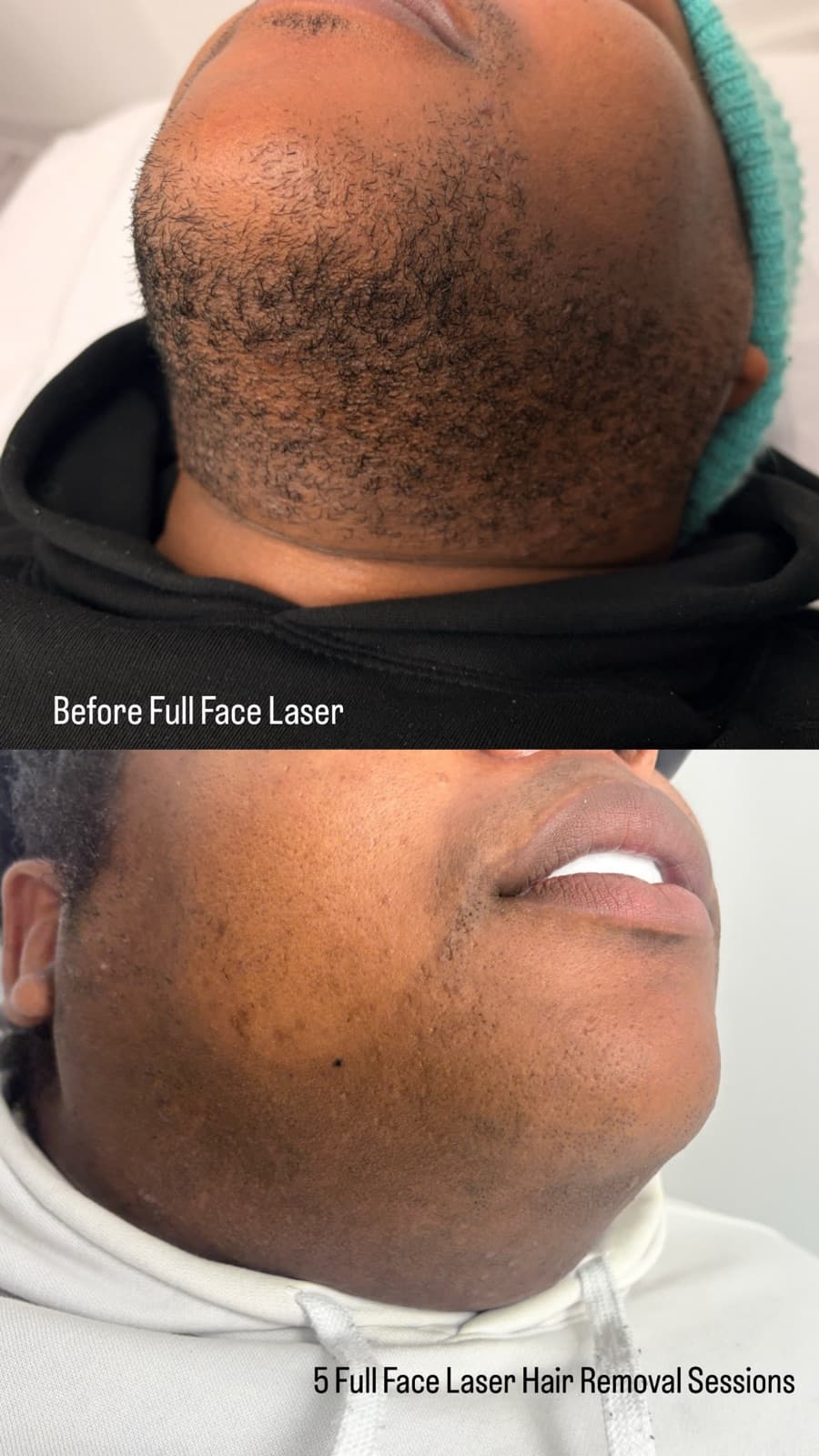 Lip filler results photographed after swelling settled