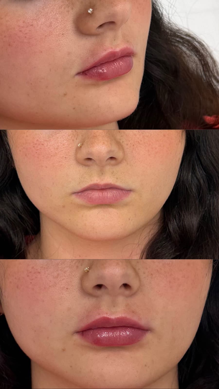 Lip filler adding balanced volume and definition