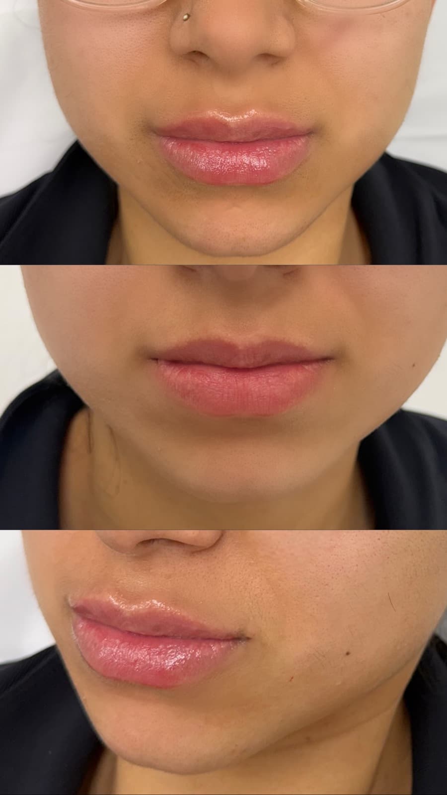 A Restylane Kysse lip enhancement