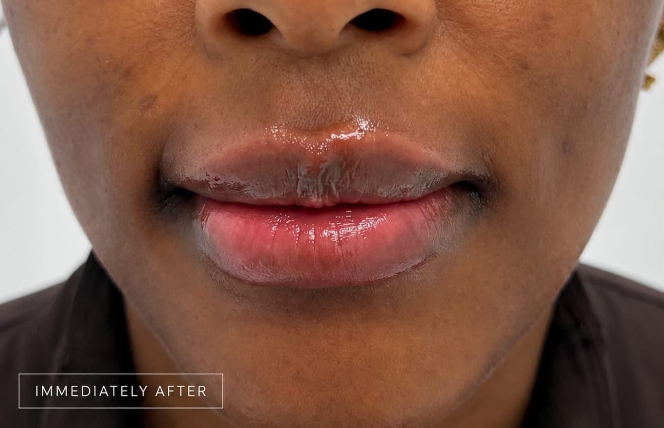 Dermal Fillers